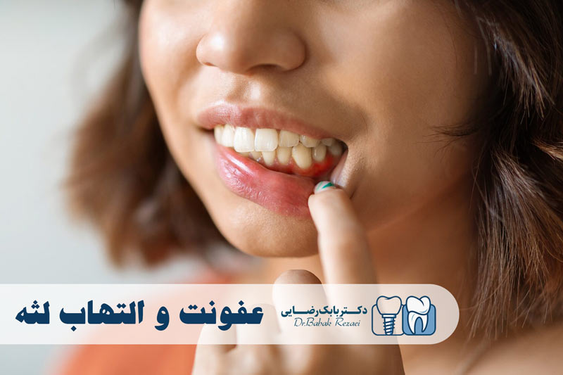 عفونت و التهاب لثه