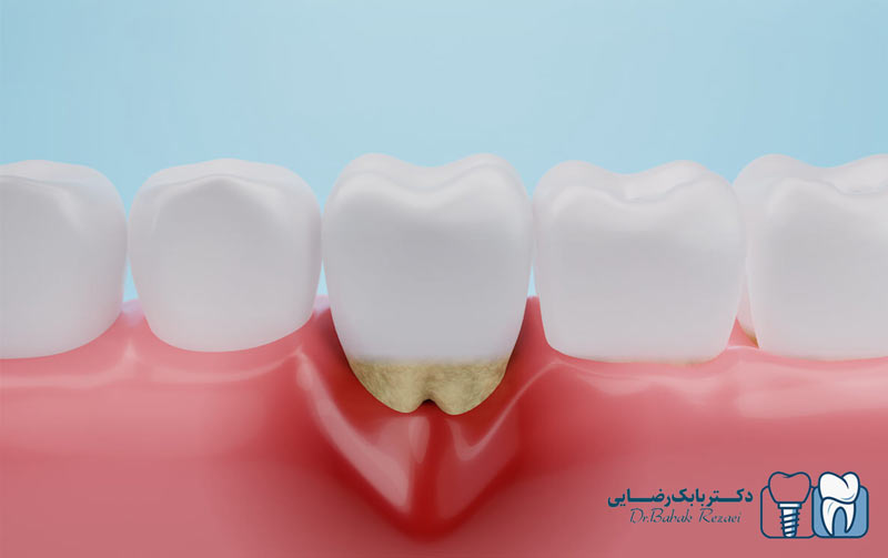 عفونت لثه: علائم و درمان