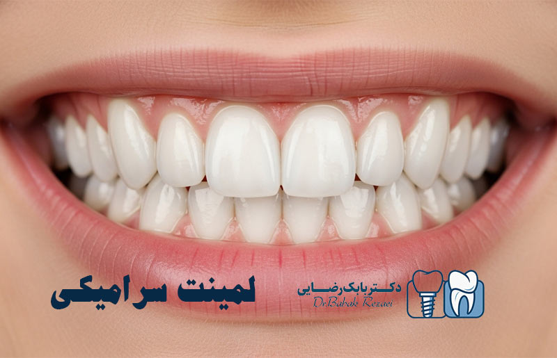 لمینت سرامیکی