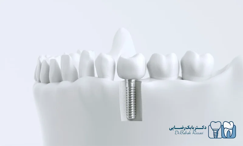 درد ایمپلنت
