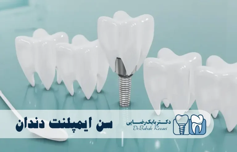 بهترین سن ایمپلنت دندان
