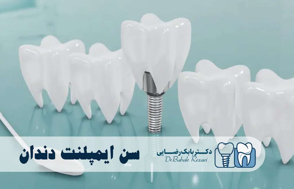 بهترین سن ایمپلنت دندان