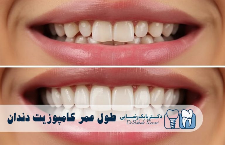 طول عمر کامپوزیت دندان
