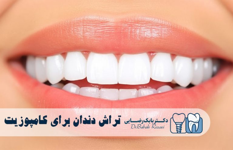 تراش دندان برای کامپوزیت