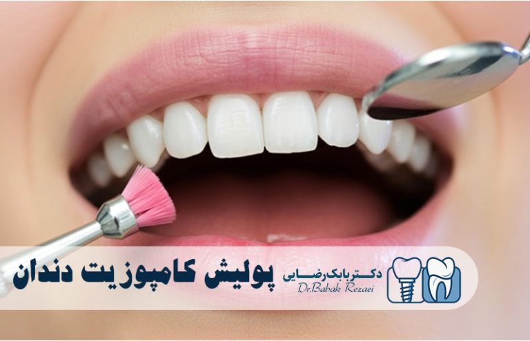 پولیش کامپوزیت دندان
