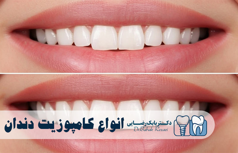 انواع کامپوزیت دندان