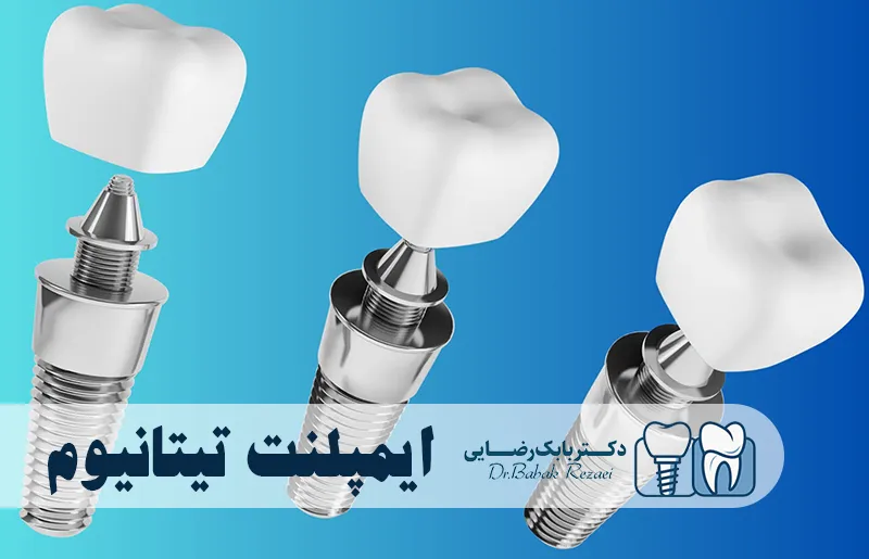 ایمپلنت تیتانیوم
