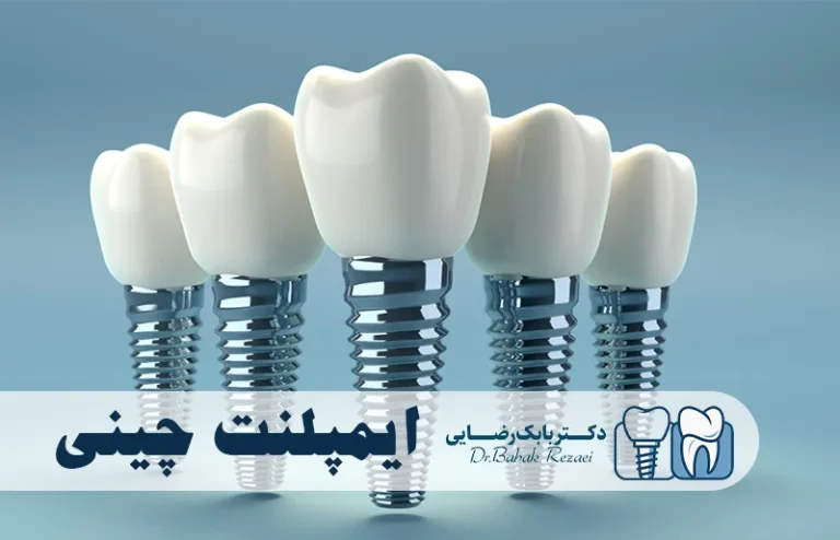 ایمپلنت دندان چینی