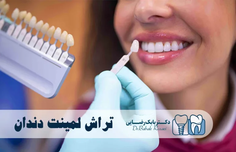 تراش لمینت دندان