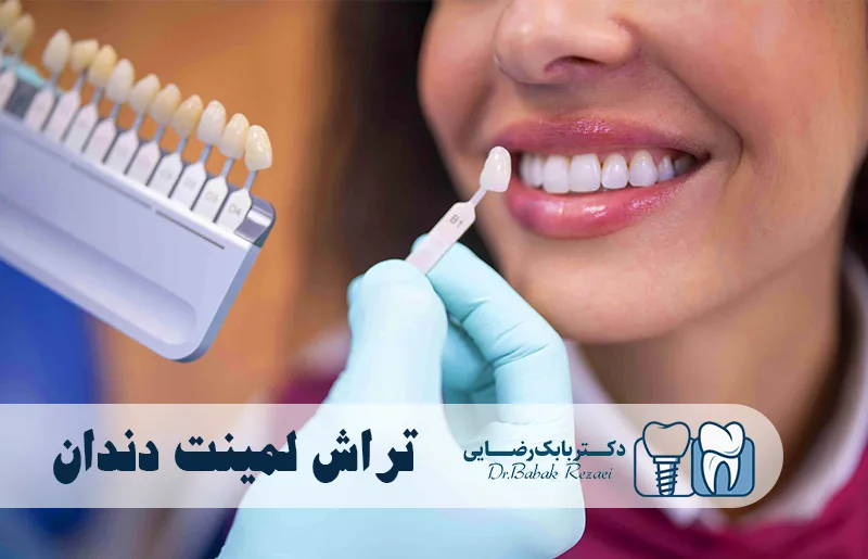 تراش لمینت دندان