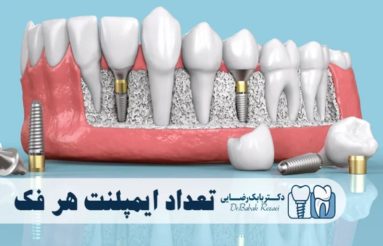 تعداد ایمپلنت برای هر فک
