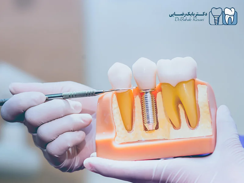 تعداد ایمپلنت لازم