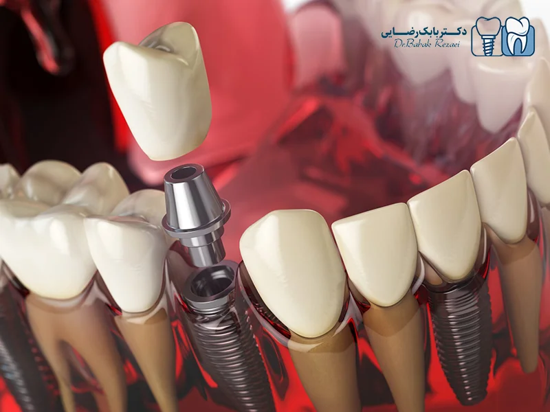 تعداد ایمپلنت برای هر فک