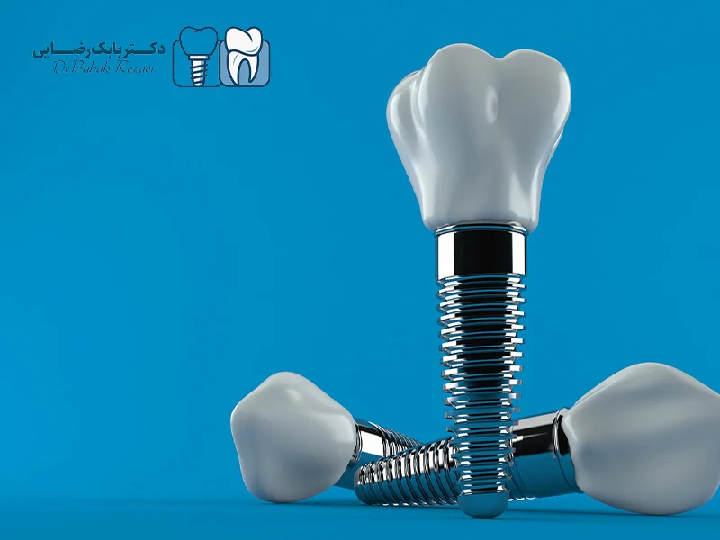 تعداد ایمپلنت برای هر فک