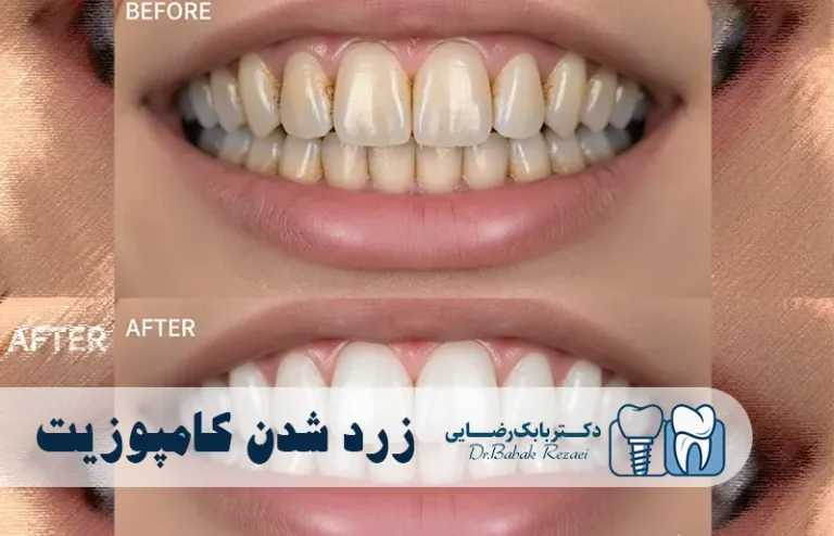 زردی شدن کامپوزیت دندان