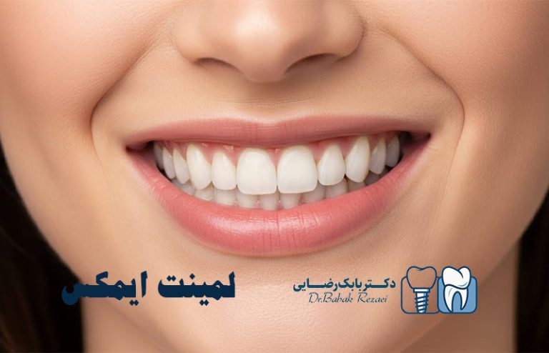 لمینت ایمکس EMax