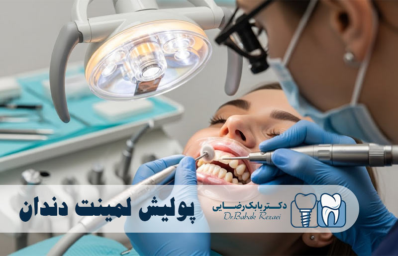 پولیش لمینت دندان