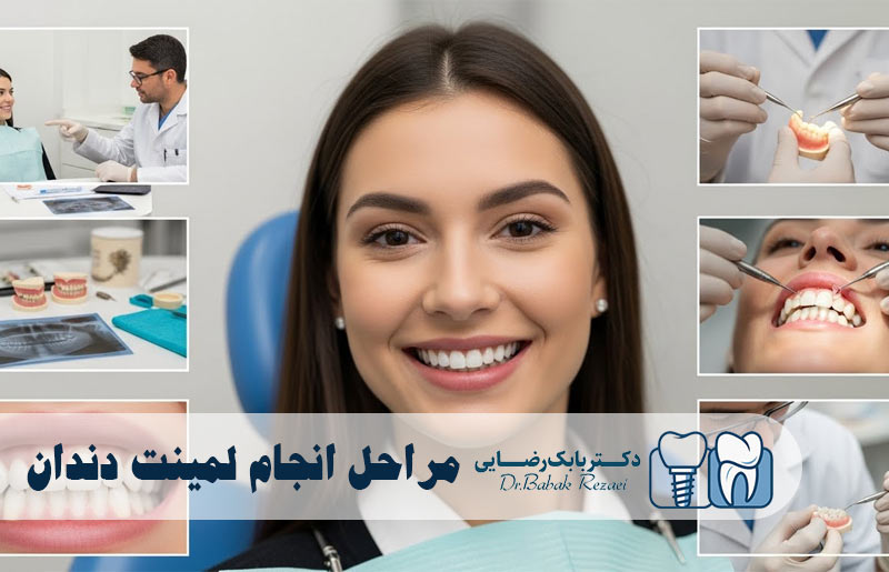 مراحل انجام لمینت دندان