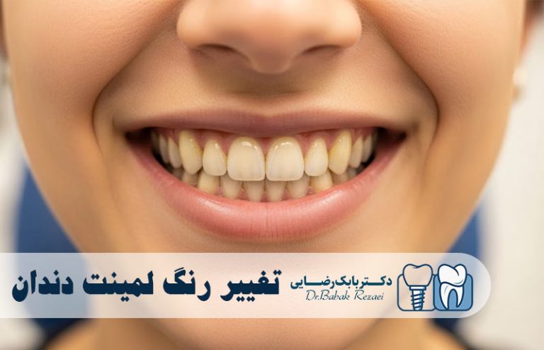 تغییر رنگ لمینت دندان