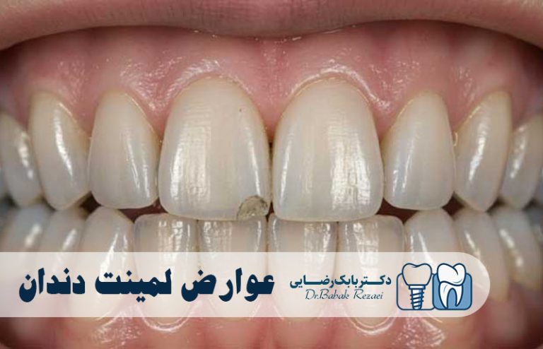 عوارض لمینت دندان