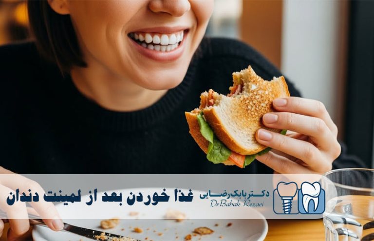 غذا خوردن بعد از لمینت دندان