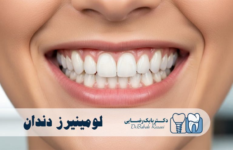 لومینیرز دندان