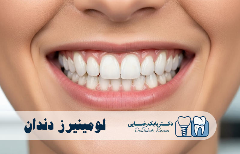 لومینیرز دندان