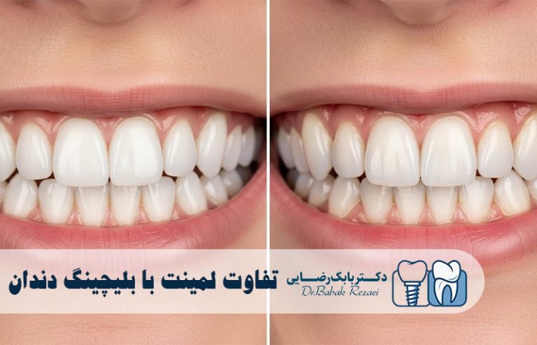 تفاوت لمینت با بلیچینگ دندان