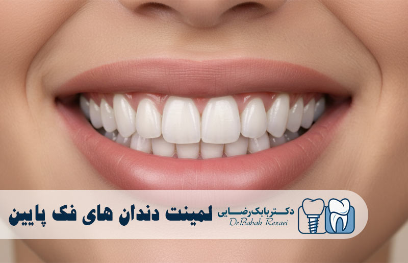 لمینت دندان های فک پایین