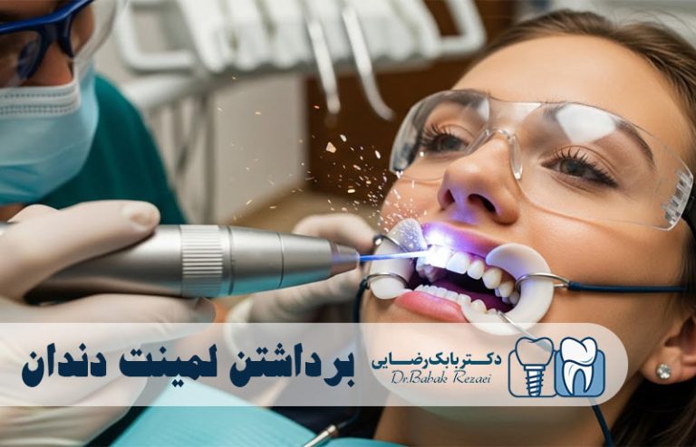 برداشتن لمینت دندان