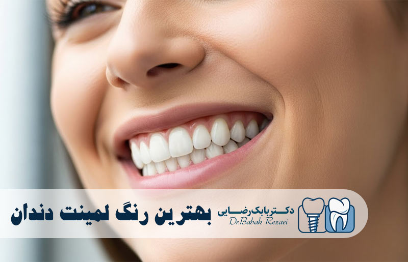 بهترین رنگ لمینت دندان