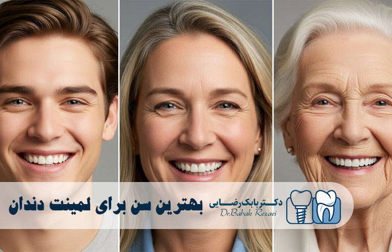 بهترین سن برای لمینت دندان