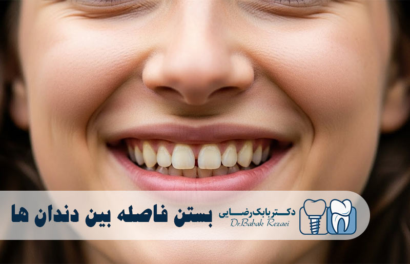 بستن فاصله بین دندان ها