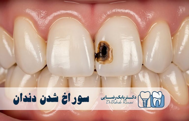 سوراخ شدن دندان