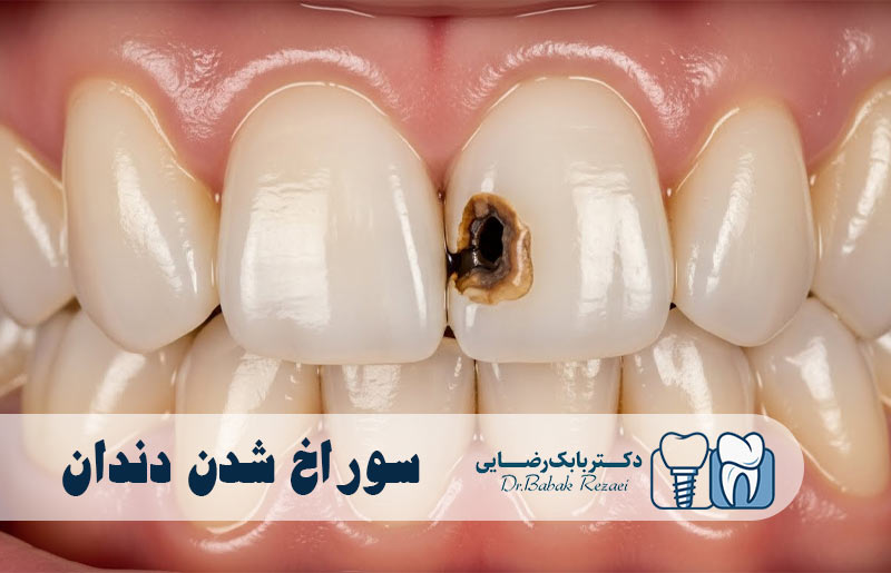 سوراخ شدن دندان