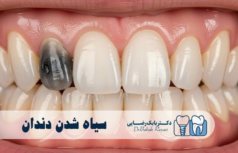 سیاه شدن دندان