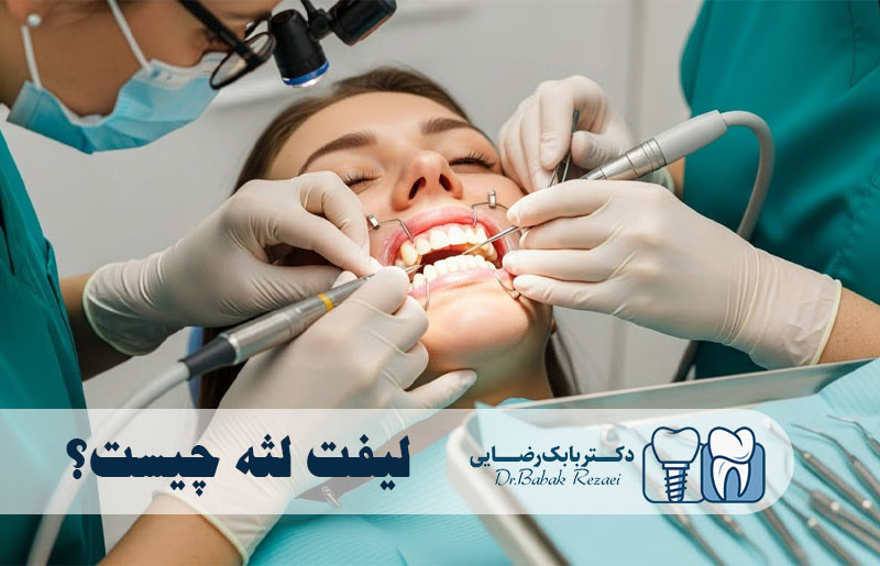 لیفت لثه چیست؟