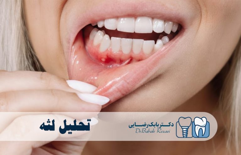 تحلیل لثه