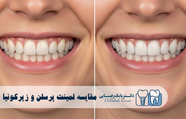 مقایسه لمینت پرسلن و زیرکونیا