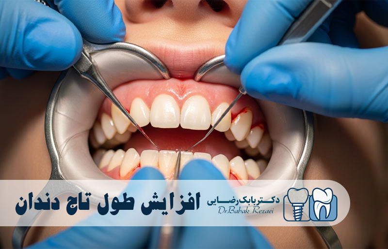 افزایش طول تاج دندان