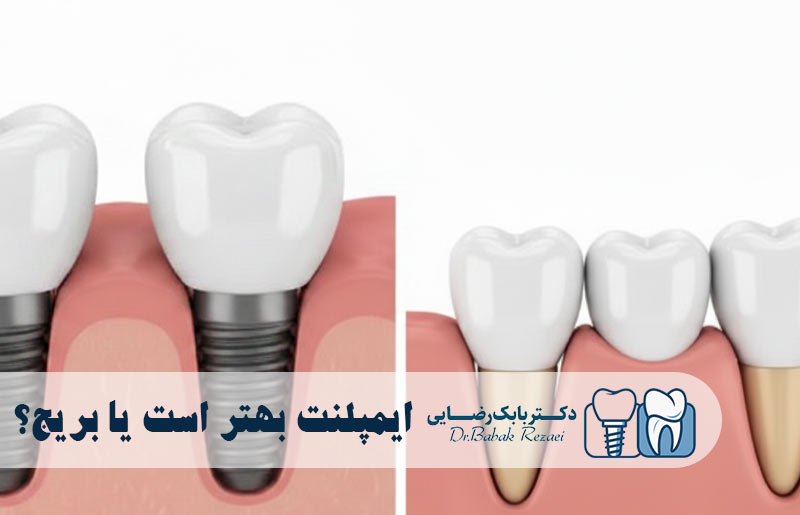 ایمپلنت بهتر است یا بریج؟