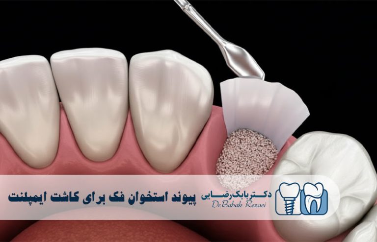 پیوند استخوان فک برای کاشت ایمپلنت